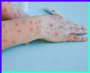 The Mpox Outbreak Understanding the Global Public Health Emergency