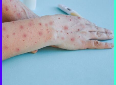The Mpox Outbreak Understanding the Global Public Health Emergency